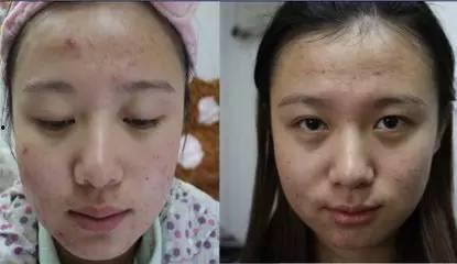 刮痧女视频,传统养生与现代视觉的完美融合